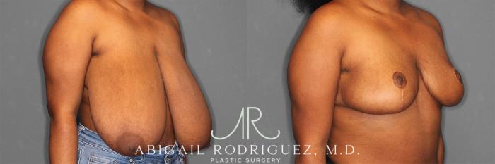 Before & After Breast Reduction Case 258301 View 5 View in Houston, TX
