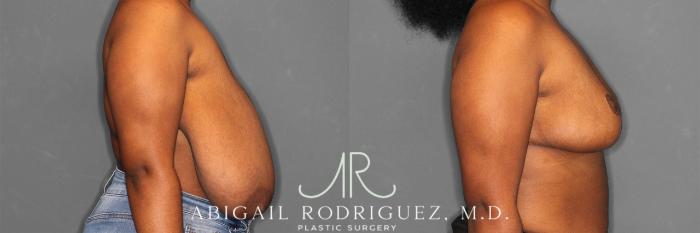 Before & After Breast Reduction Case 258301 View 6 View in Houston, TX
