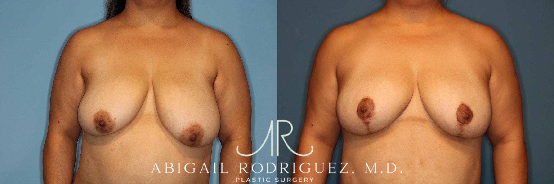 Before & After Breast Reduction Case 258343 View 1 View in Houston, TX