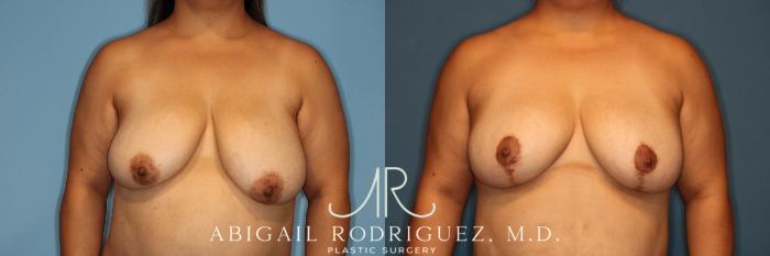 Before & After Breast Reduction Case 258343 View 1 View in Houston, TX