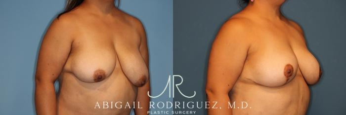Before & After Breast Reduction Case 258343 View 2 View in Houston, TX