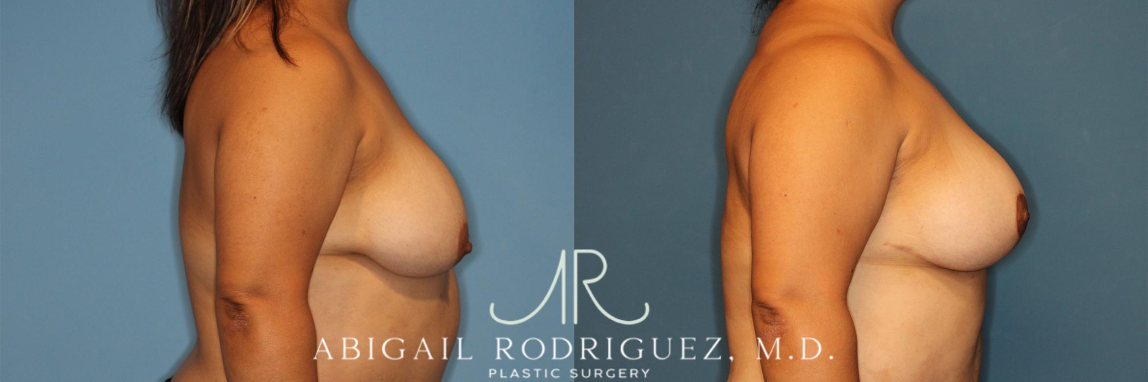 Before & After Breast Reduction Case 258343 View 3 View in Houston, TX
