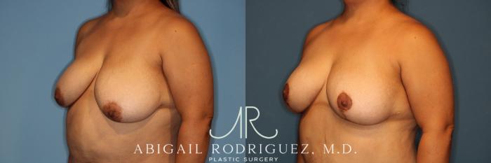 Before & After Breast Reduction Case 258343 View 4 View in Houston, TX