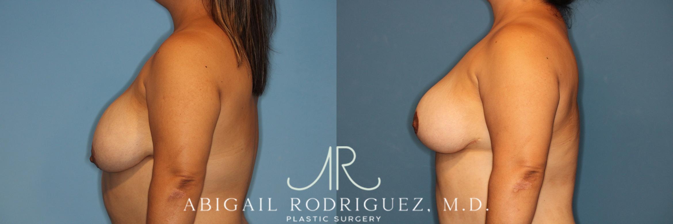 Before & After Breast Reduction Case 258343 View 5 View in Houston, TX