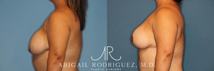 Before & After Breast Reduction Case 258343 View 5 View in Houston, TX