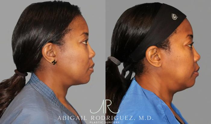 Before & After Breast Reduction Case 345990 View 4 View in Houston, TX