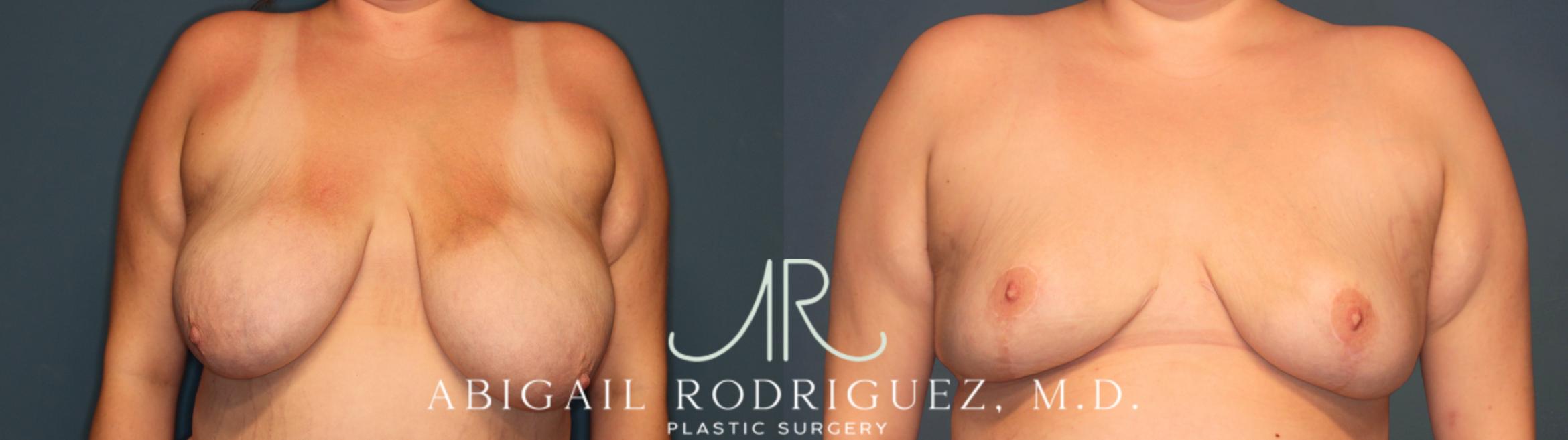Before & After Breast Reduction Case 346005 Front View in Houston, TX