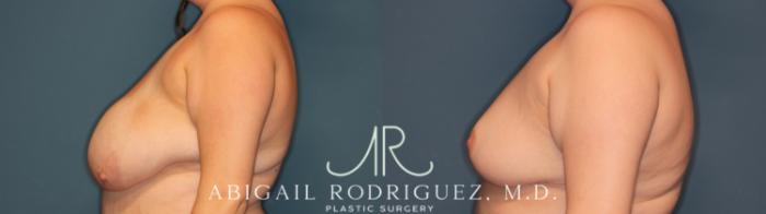 Before & After Breast Reduction Case 346005 Left Side View in Houston, TX