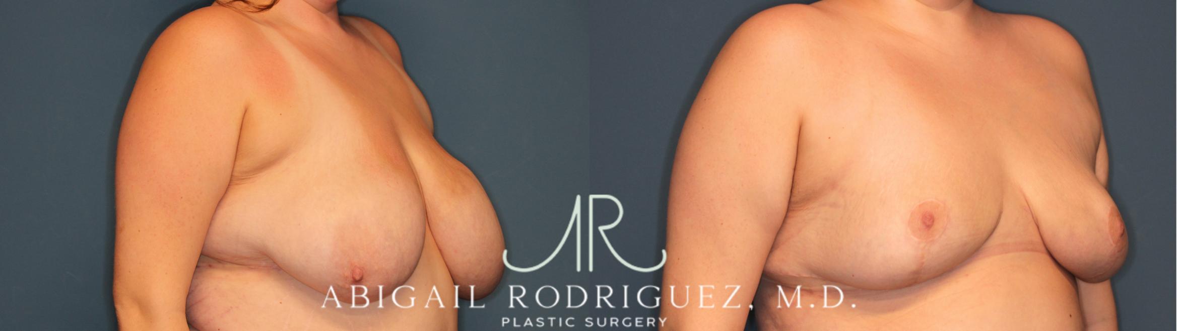 Before & After Breast Reduction Case 346005 Right Oblique View in Houston, TX