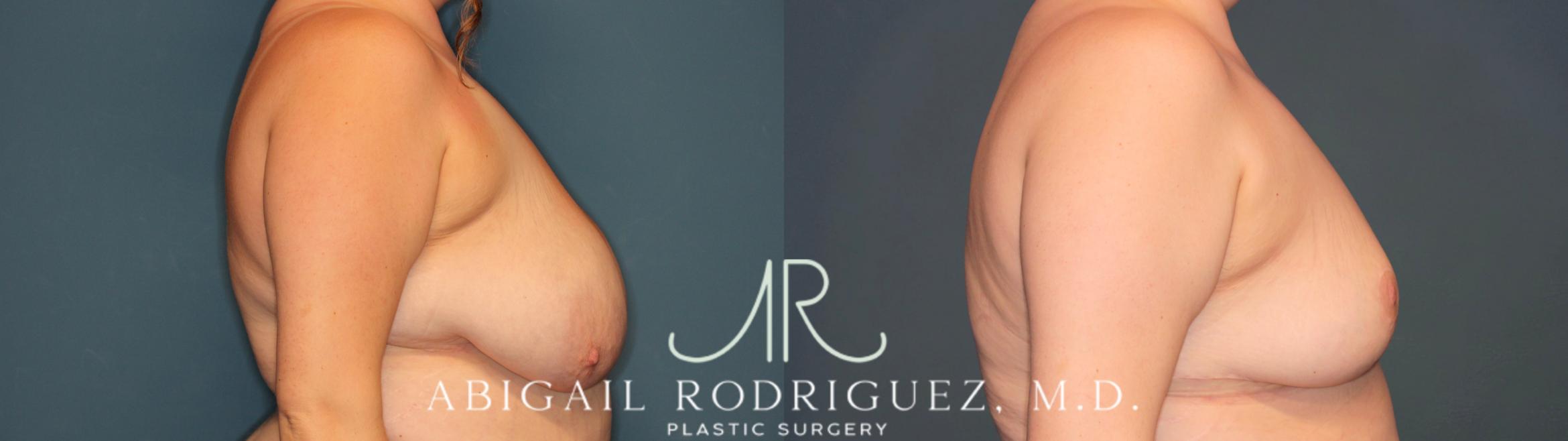 Before & After Breast Reduction Case 346005 Right Side View in Houston, TX