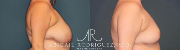 Before & After Breast Reduction Case 346005 Right Side View in Houston, TX