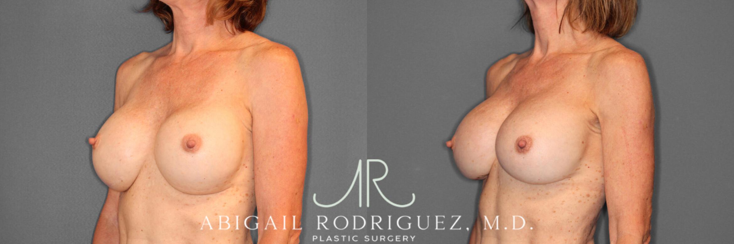 Before & After Breast Revision Case 254015 View 2 View in Houston, TX