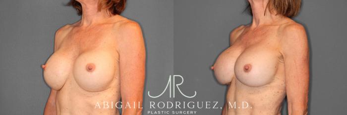 Before & After Breast Revision Case 254015 View 2 View in Houston, TX
