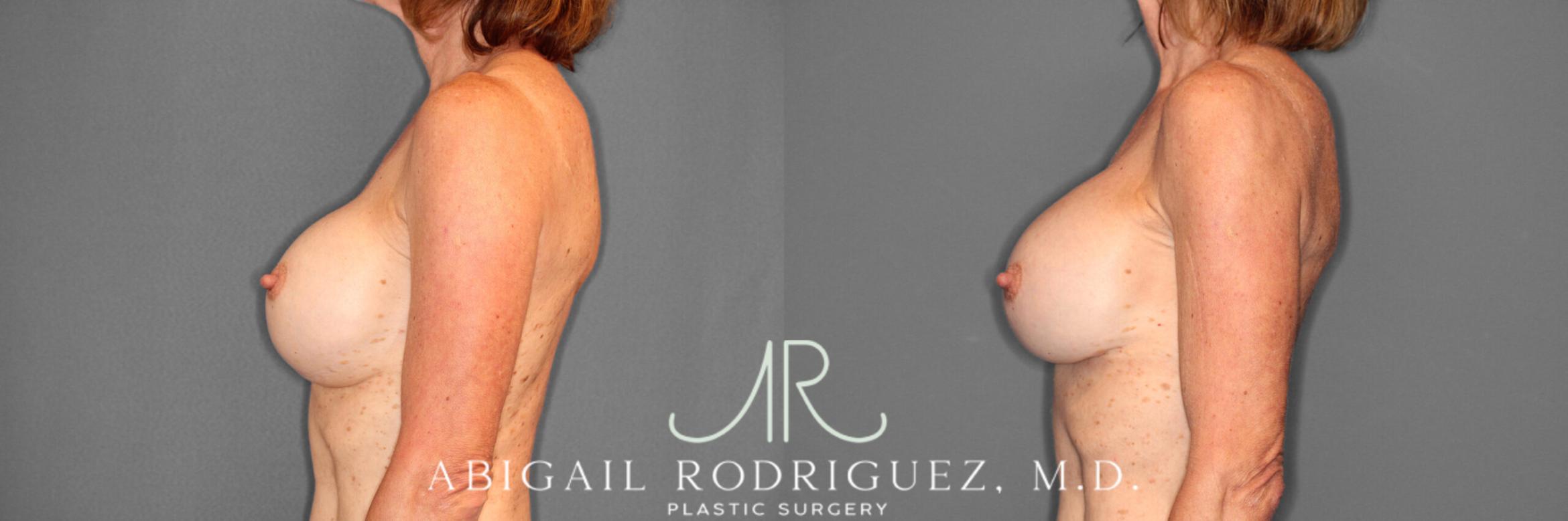 Before & After Breast Revision Case 254015 View 3 View in Houston, TX