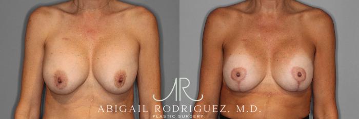 Before & After Breast Lift Case 254547 View 1 View in Houston, TX