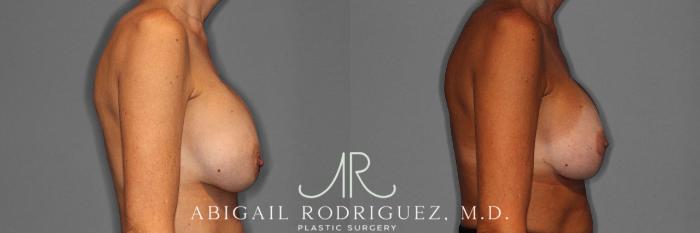 Before & After Breast Revision Case 254547 View 2 View in Houston, TX