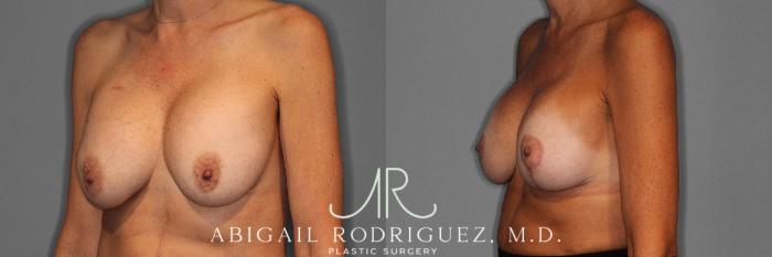 Before & After Breast Revision Case 254547 View 3 View in Houston, TX