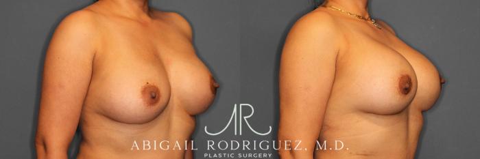 Before & After Breast Revision Case 254810 View 2 View in Houston, TX