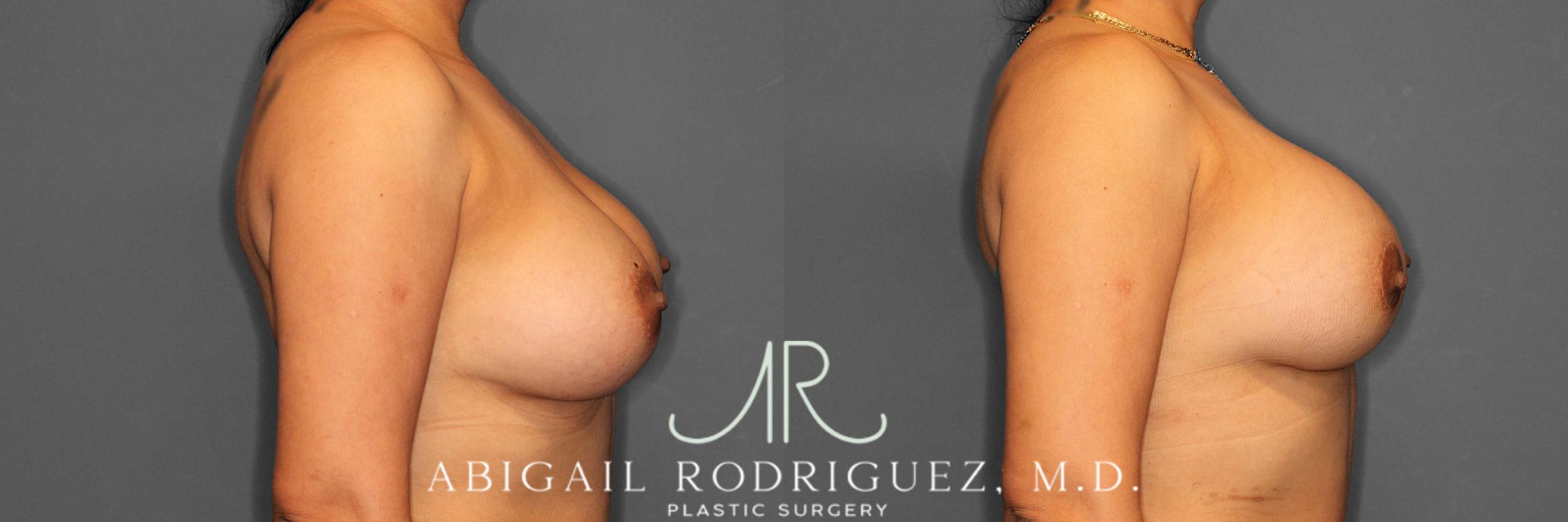 Before & After Breast Revision Case 254810 View 3 View in Houston, TX