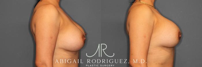 Before & After Breast Revision Case 254810 View 3 View in Houston, TX