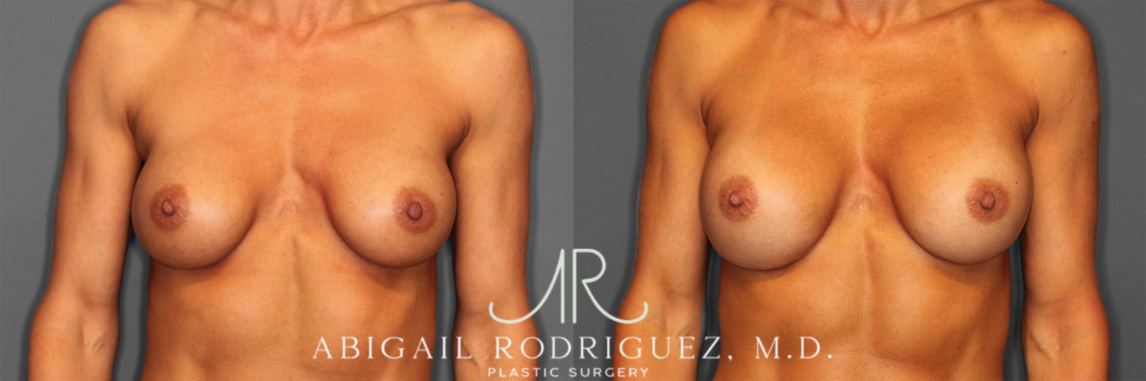 Before & After Breast Revision Case 257477 View 2 View in Houston, TX