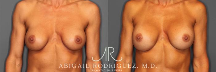 Before & After Breast Revision Case 257477 View 2 View in Houston, TX