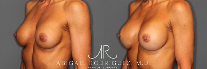 Before & After Breast Revision Case 257477 View 3 View in Houston, TX