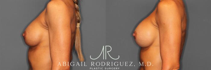 Before & After Breast Revision Case 257477 View 4 View in Houston, TX