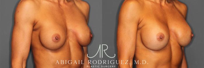 Before & After Breast Revision Case 257477 View 5 View in Houston, TX