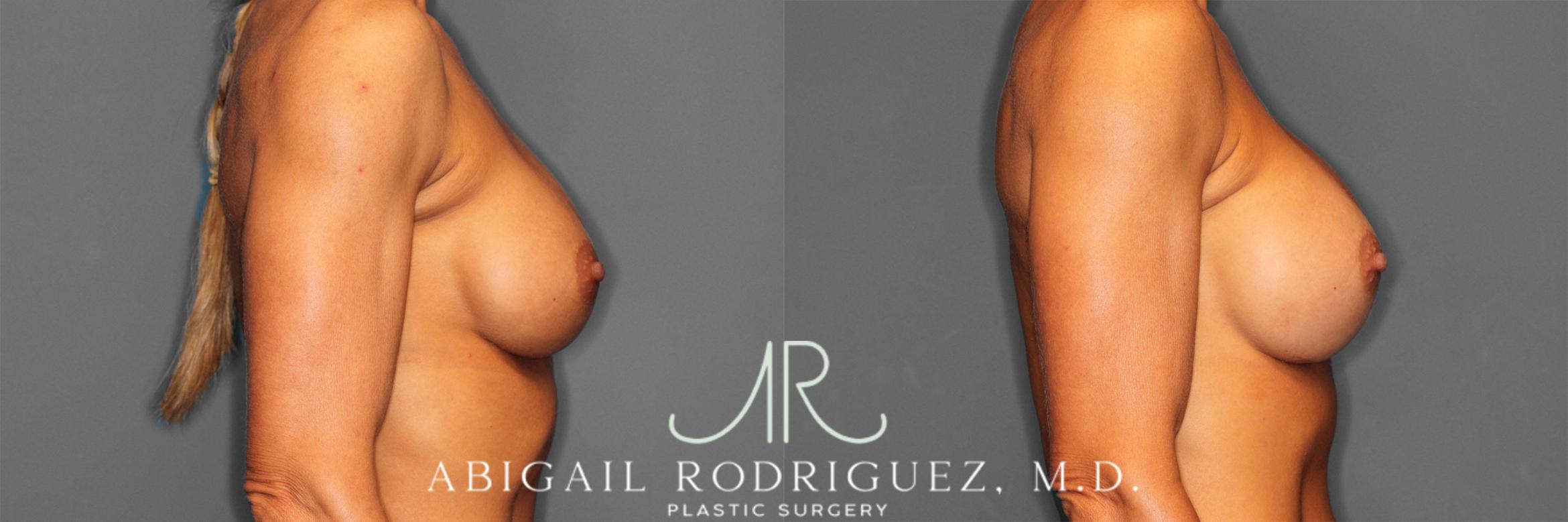 Before & After Breast Revision Case 257477 View 6 View in Houston, TX