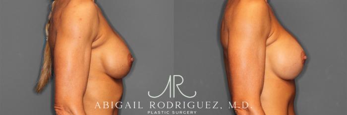 Before & After Breast Revision Case 257477 View 6 View in Houston, TX