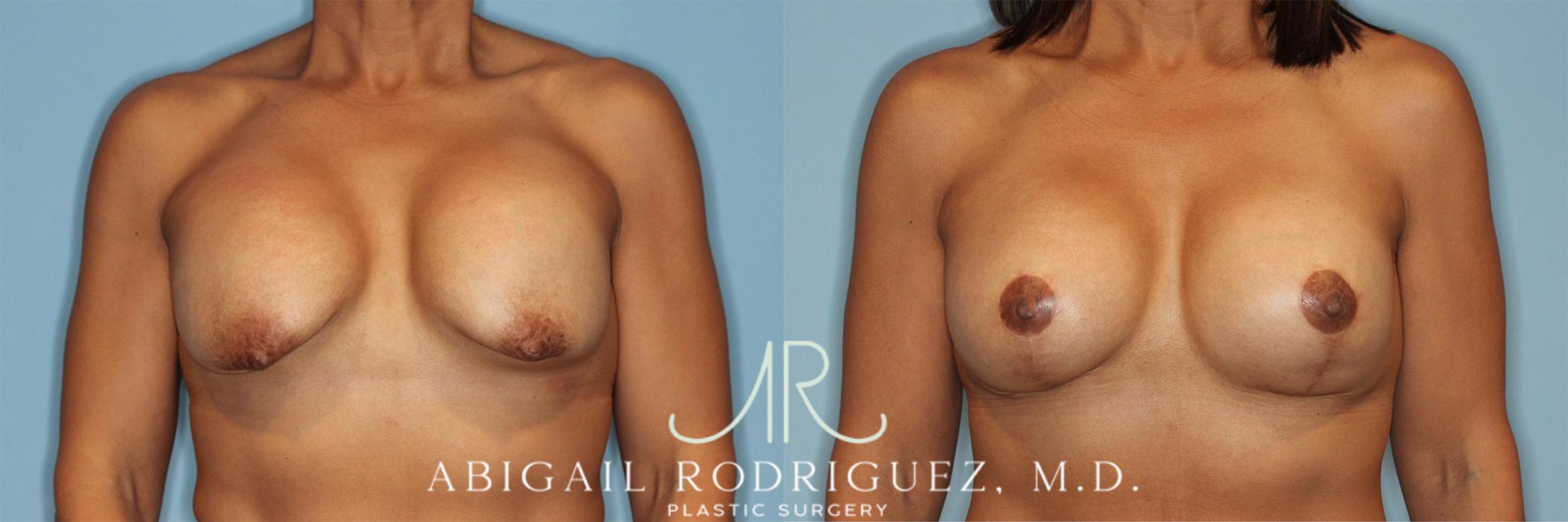 Before & After Breast Revision Case 258323 View 1 View in Houston, TX