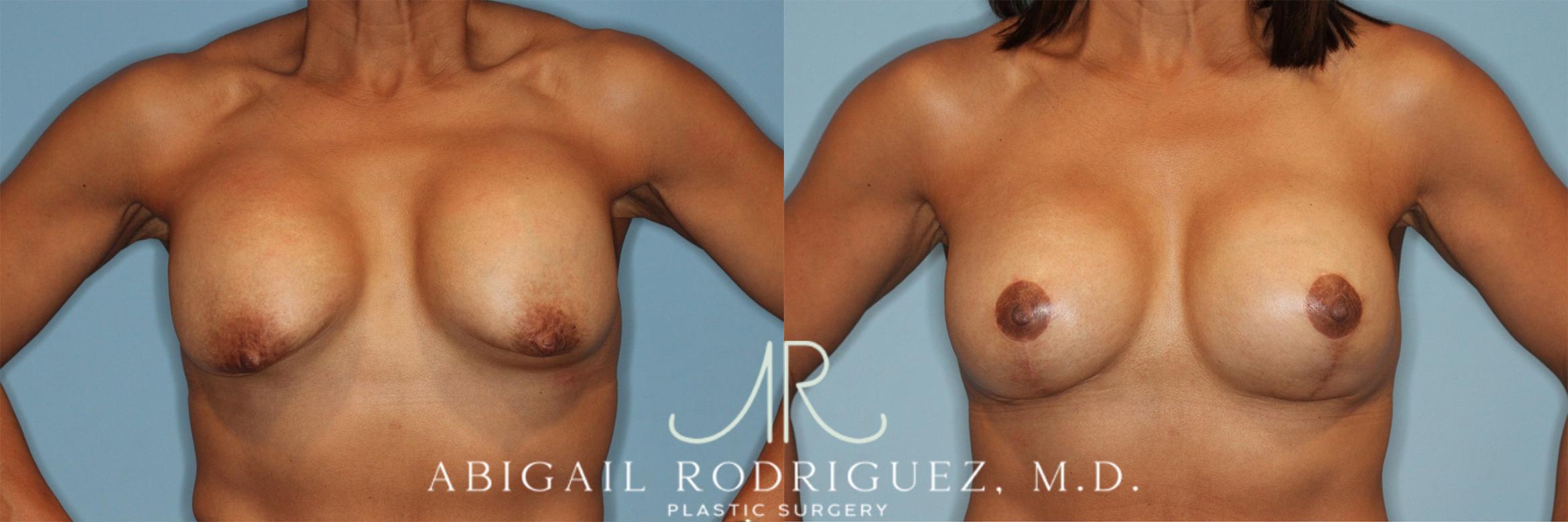 Before & After Breast Revision Case 258323 View 2 View in Houston, TX