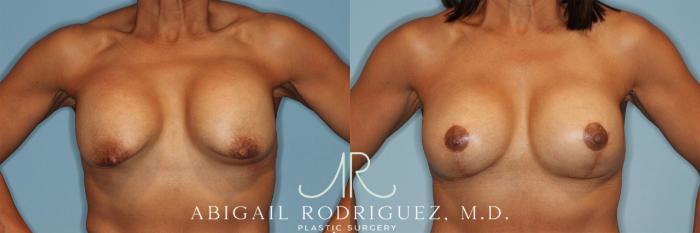 Before & After Breast Revision Case 258323 View 2 View in Houston, TX