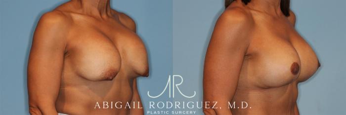 Before & After Breast Revision Case 258323 View 3 View in Houston, TX