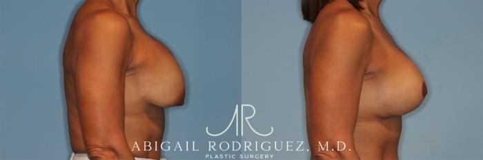 Before & After Breast Revision Case 258323 View 4 View in Houston, TX