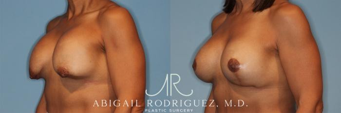 Before & After Breast Revision Case 258323 View 5 View in Houston, TX