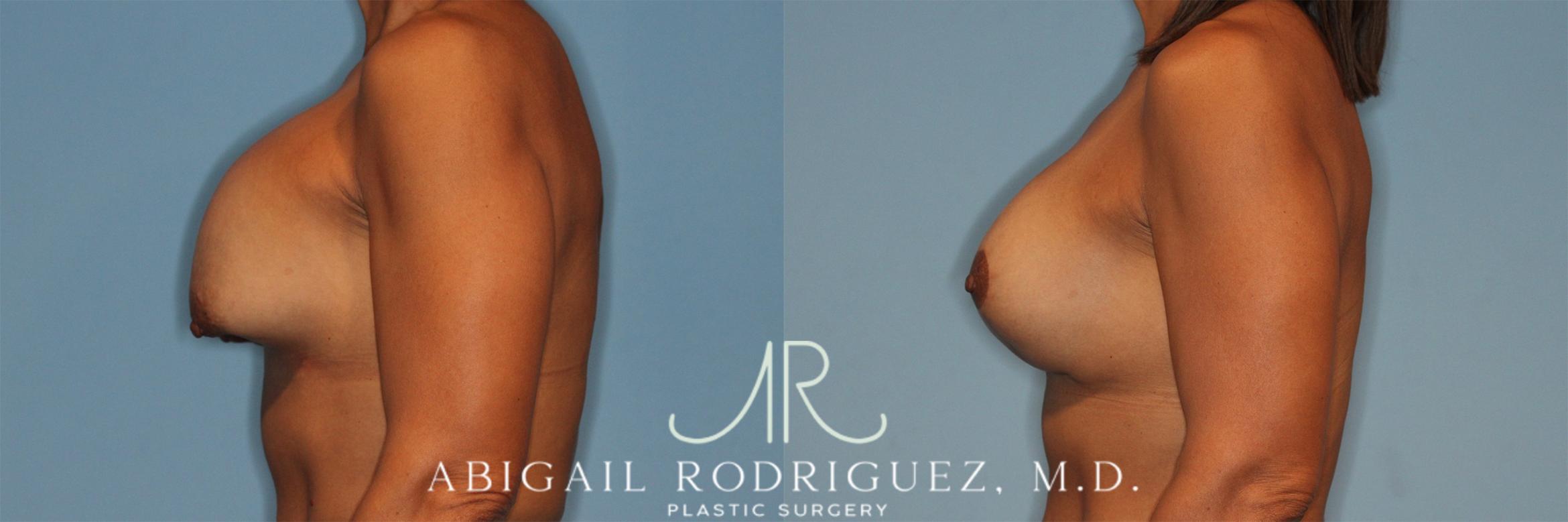 Before & After Breast Revision Case 258323 View 6 View in Houston, TX