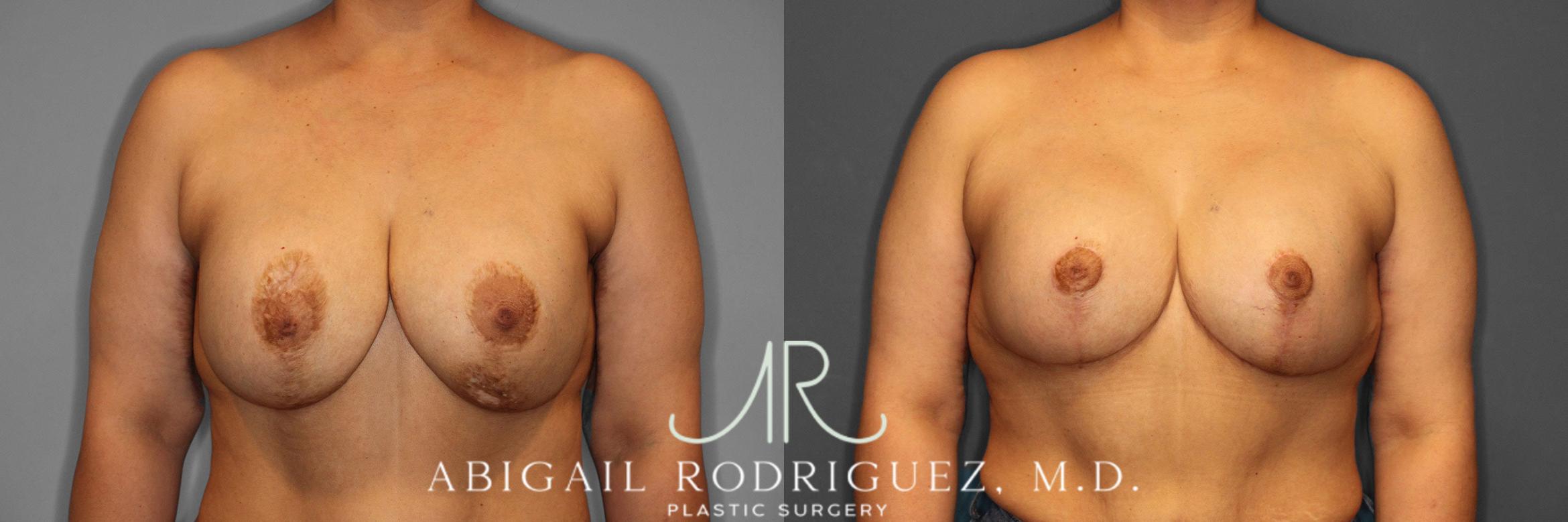 Before & After Breast Revision Case 258459 View 1 View in Houston, TX