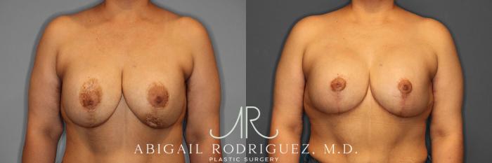 Before & After Breast Revision Case 258459 View 1 View in Houston, TX