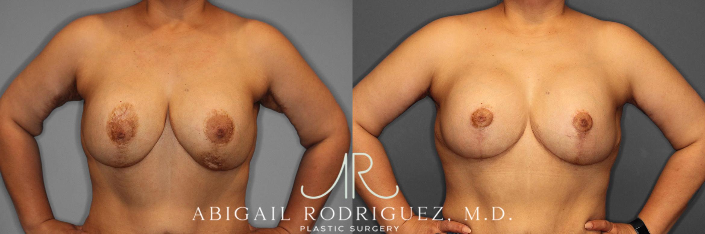 Before & After Breast Revision Case 258459 View 2 View in Houston, TX