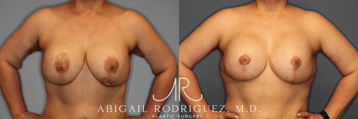 Before & After Breast Revision Case 258459 View 2 View in Houston, TX