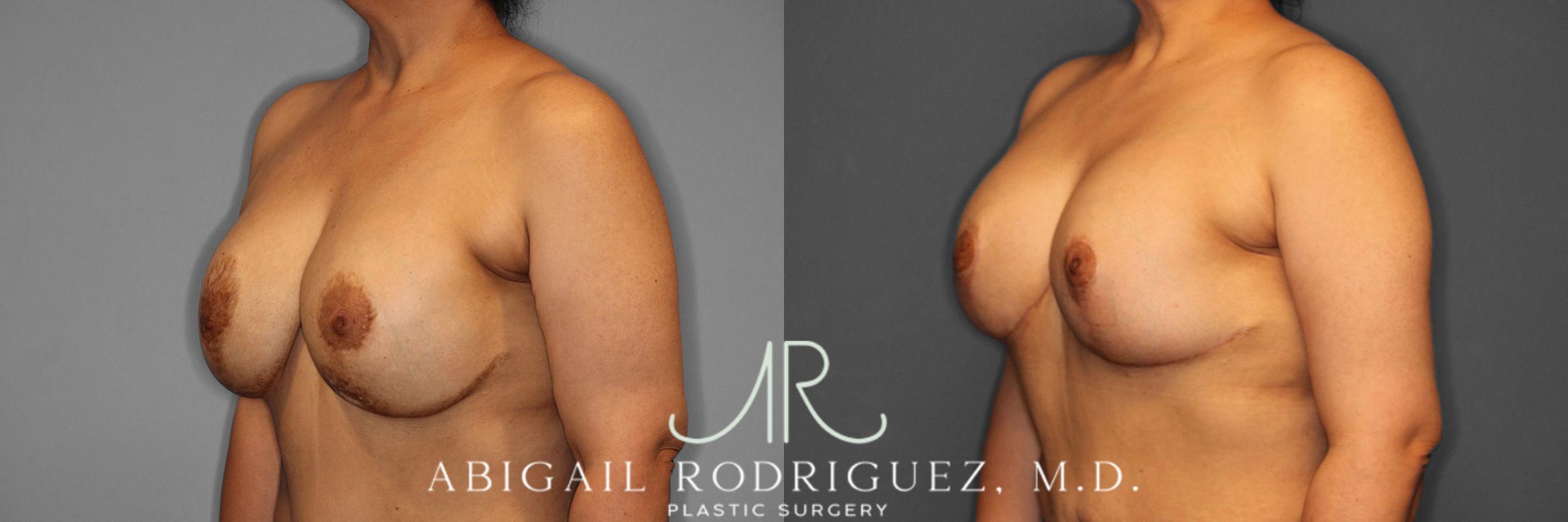 Before & After Breast Revision Case 258459 View 3 View in Houston, TX
