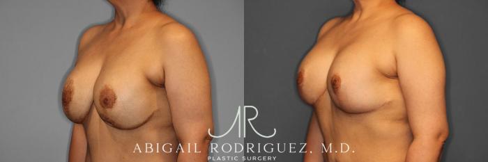 Before & After Breast Revision Case 258459 View 3 View in Houston, TX