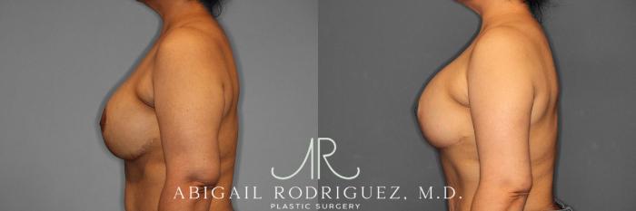 Before & After Breast Revision Case 258459 View 4 View in Houston, TX