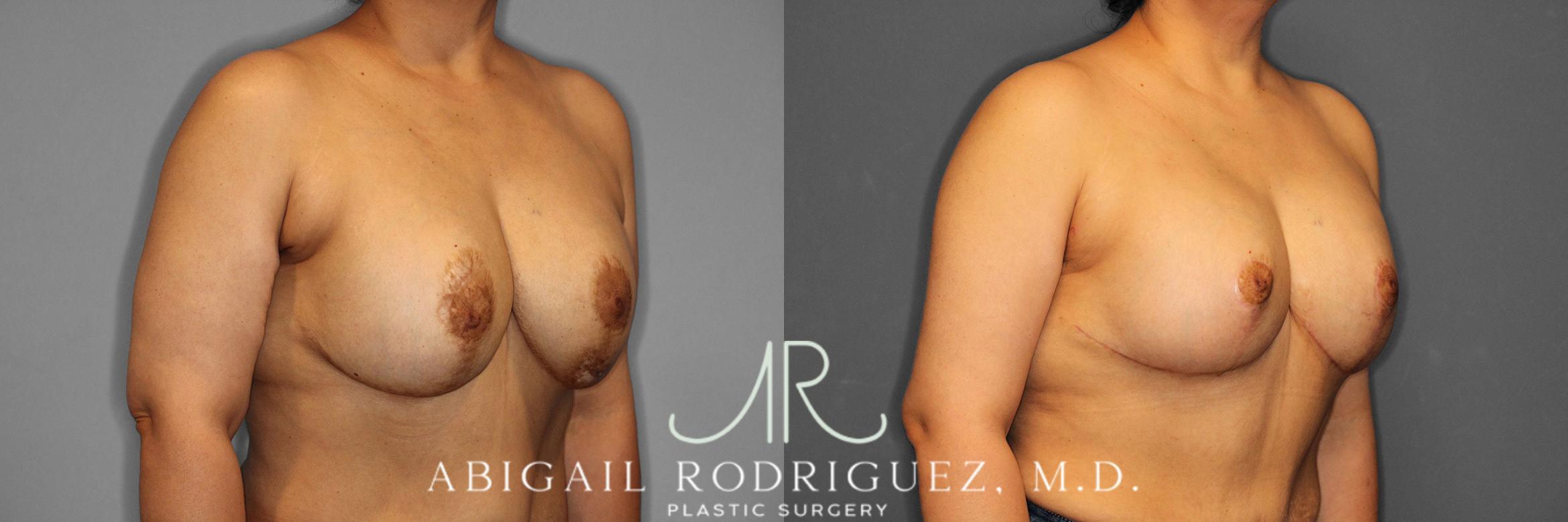 Before & After Breast Revision Case 258459 View 5 View in Houston, TX