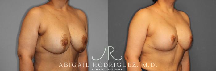 Before & After Breast Revision Case 258459 View 5 View in Houston, TX