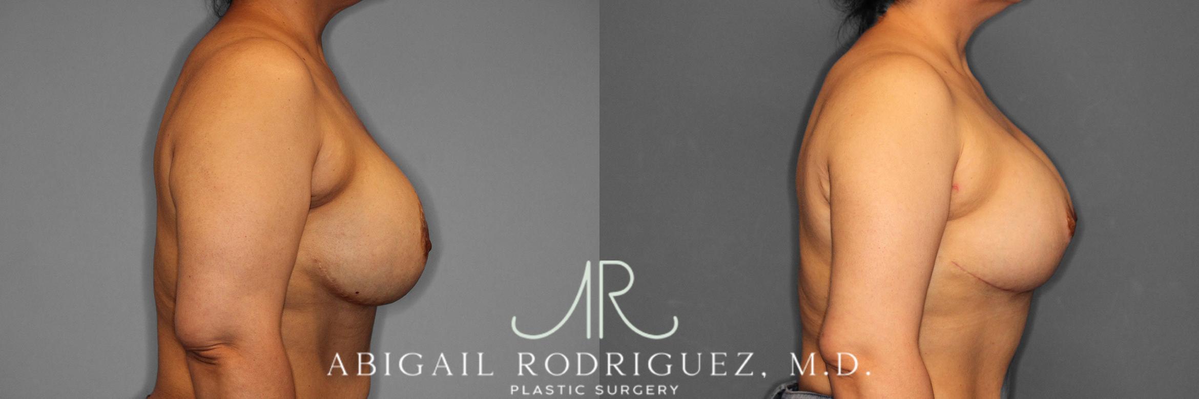 Before & After Breast Revision Case 258459 View 6 View in Houston, TX
