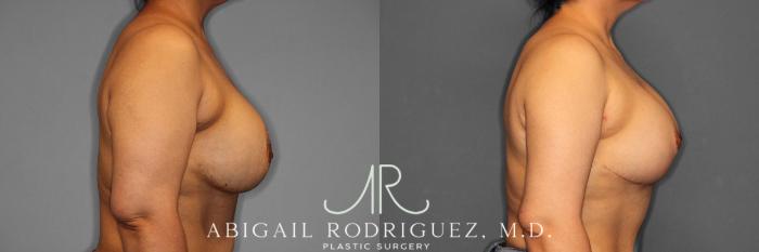 Before & After Breast Revision Case 258459 View 6 View in Houston, TX