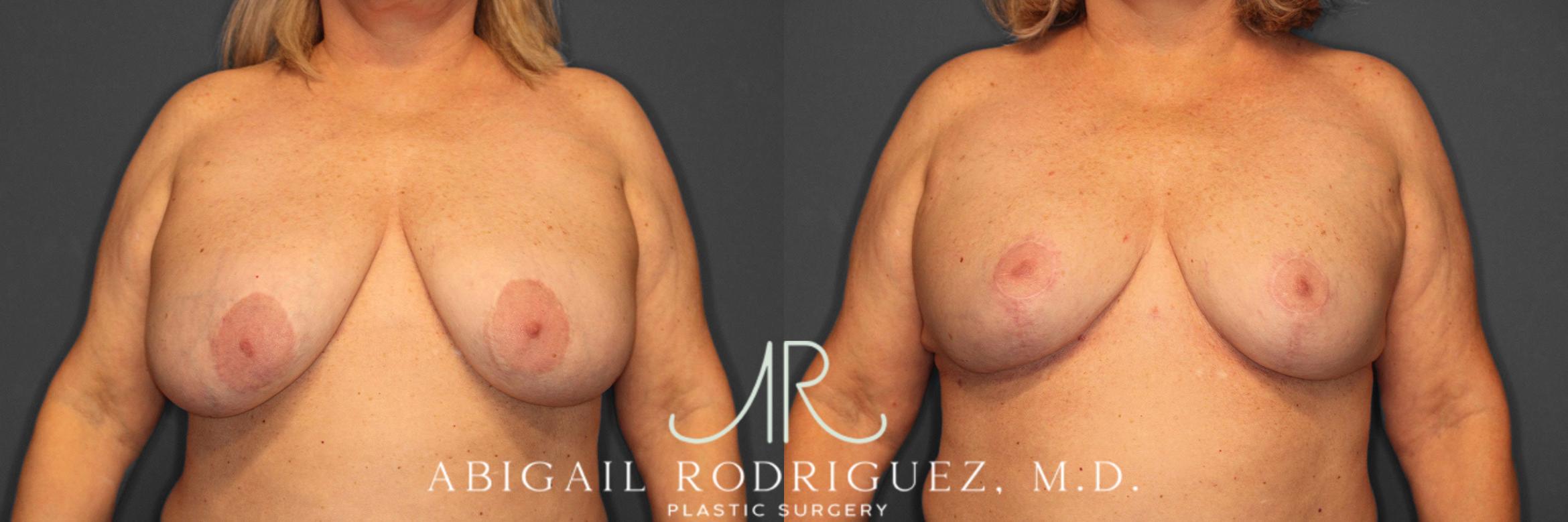 Before & After Breast Revision Case 258563 View 1 View in Houston, TX